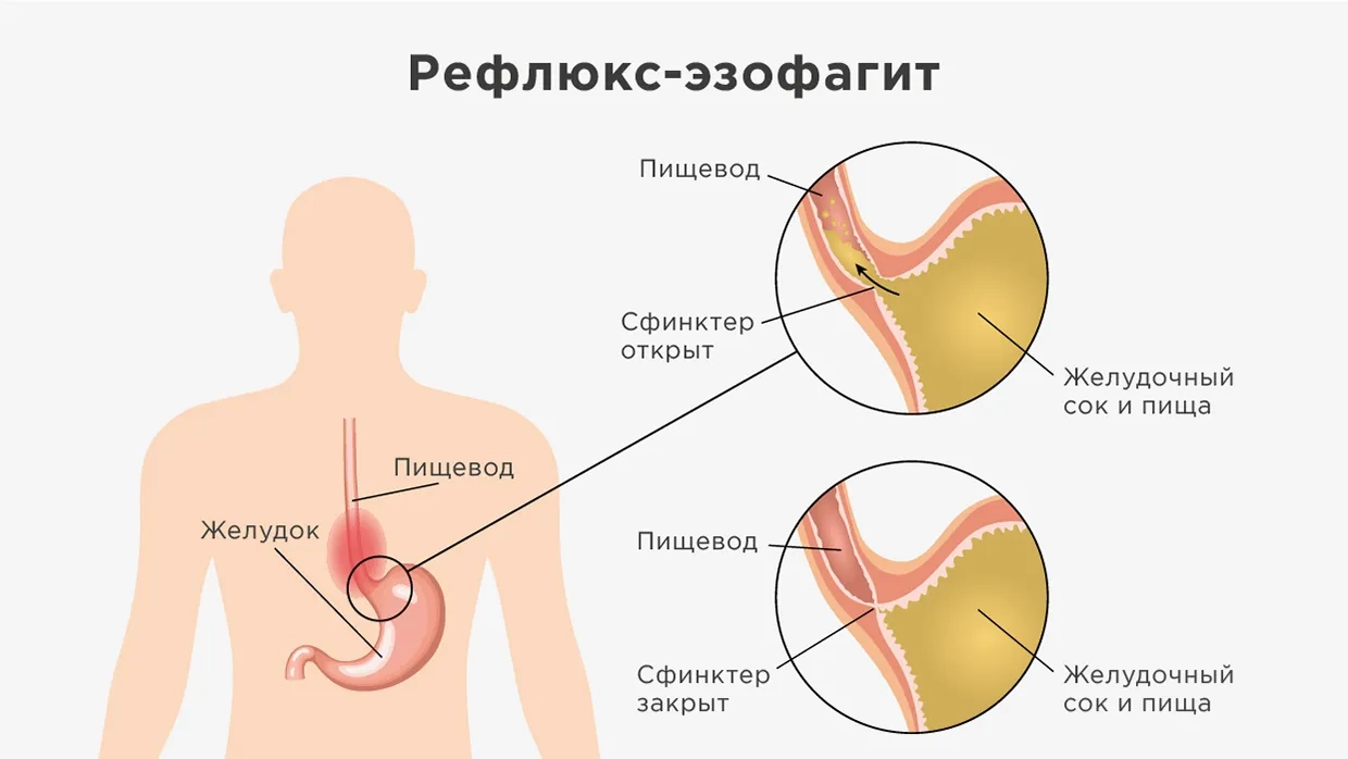 Резекция желудка - показания, виды операций и реабилитация